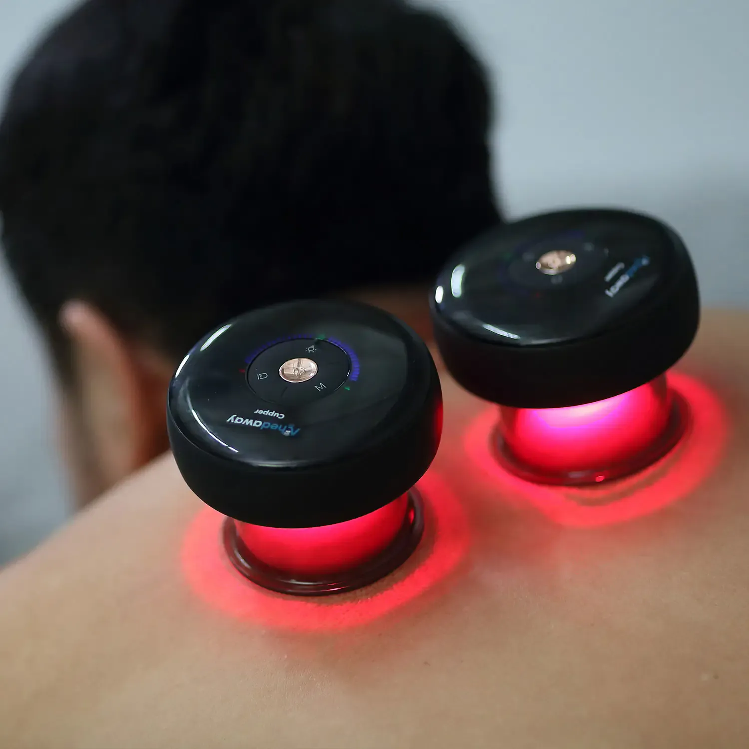 Picture of the cupping technique being used.